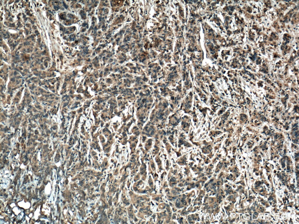 Immunohistochemistry (IHC) staining of human prostate cancer tissue using TTBK2 Polyclonal antibody (15072-1-AP)