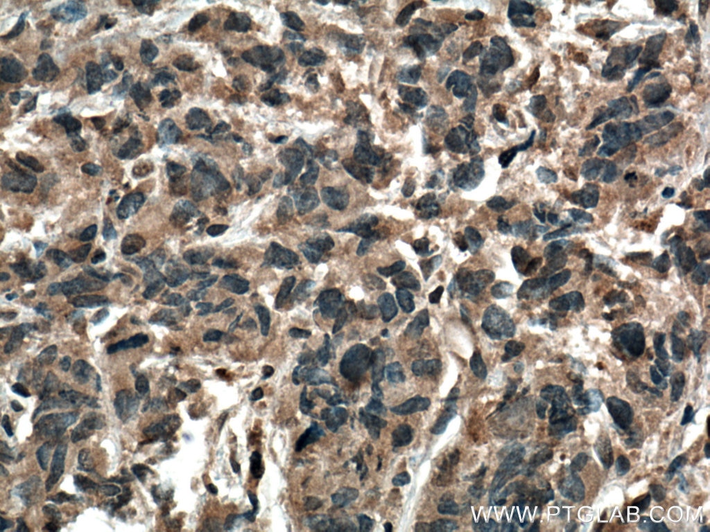 Immunohistochemistry (IHC) staining of human prostate cancer tissue using TTBK2 Polyclonal antibody (15072-1-AP)