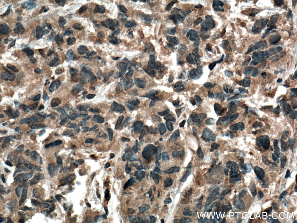 IHC staining of human prostate cancer using 15072-1-AP