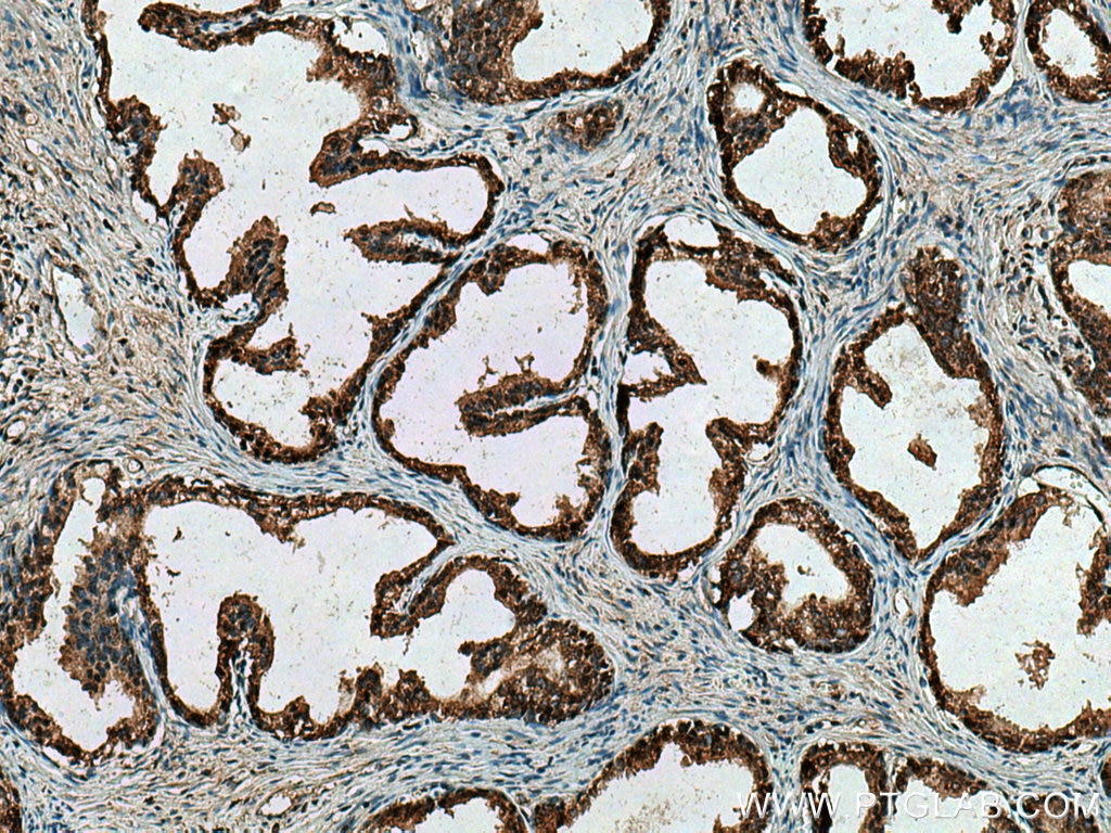 IHC staining of human prostate cancer using 15072-1-AP