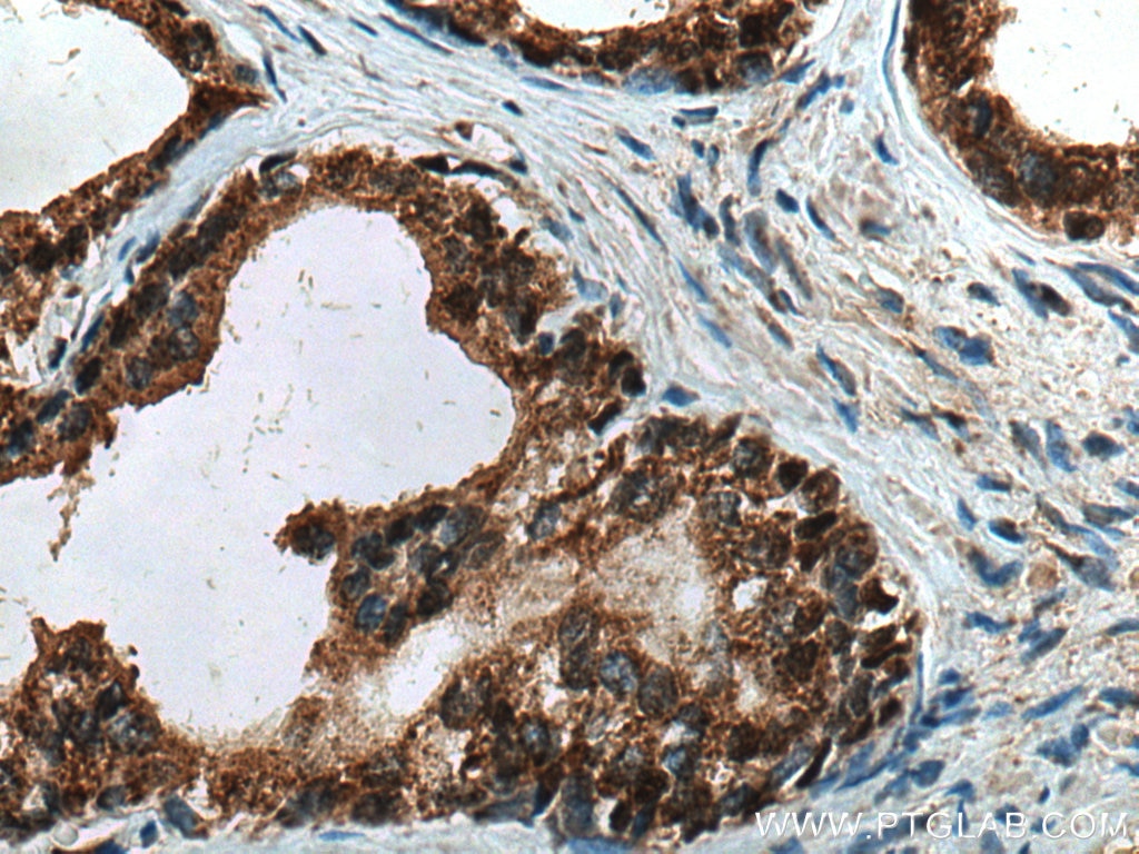 Immunohistochemistry (IHC) staining of human prostate cancer tissue using TTBK2 Polyclonal antibody (15072-1-AP)