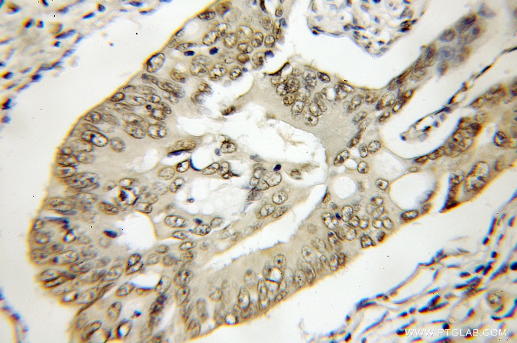 Immunohistochemistry (IHC) staining of human colon cancer tissue using TTC1 Polyclonal antibody (11676-1-AP)