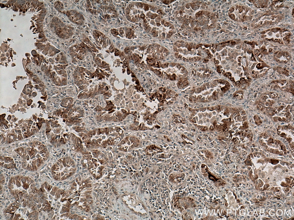 Immunohistochemistry (IHC) staining of human lung cancer tissue using TTC12 Polyclonal antibody (28216-1-AP)