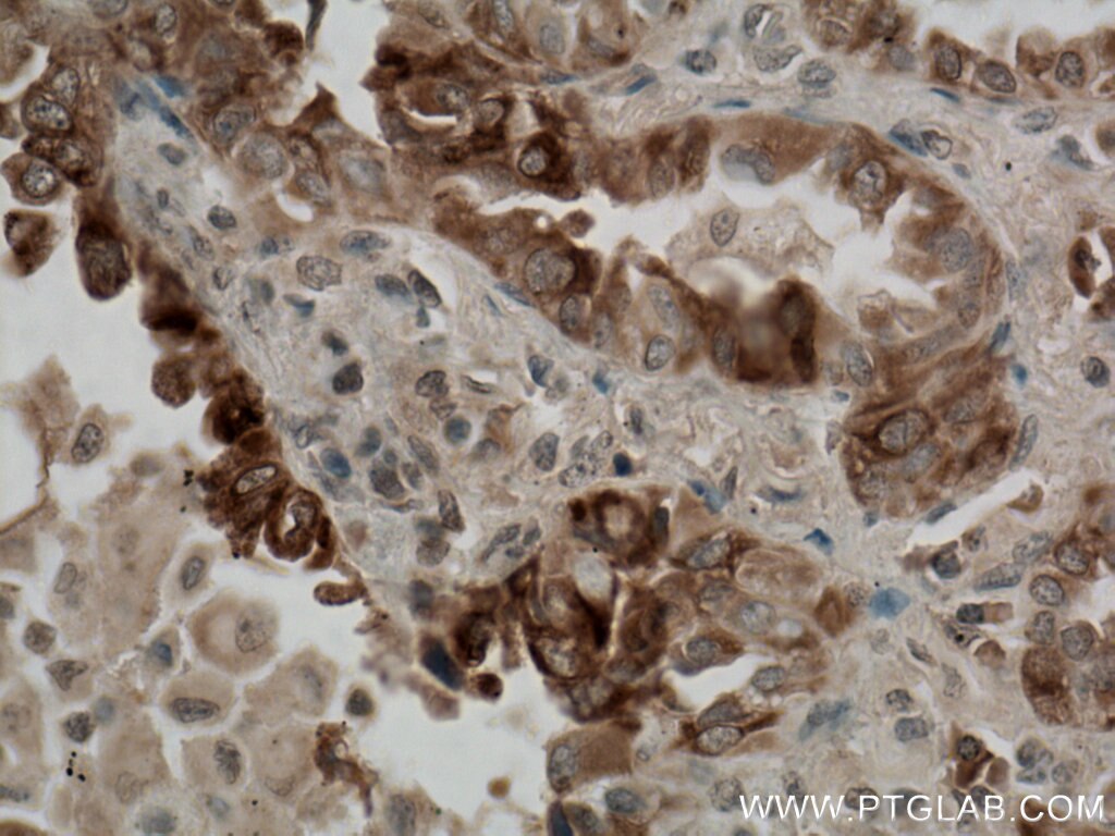 Immunohistochemistry (IHC) staining of human lung cancer tissue using TTC12 Polyclonal antibody (28216-1-AP)