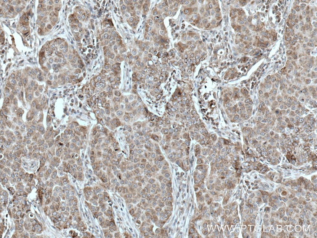 Immunohistochemistry (IHC) staining of human breast cancer tissue using TTC19 Polyclonal antibody (20875-1-AP)
