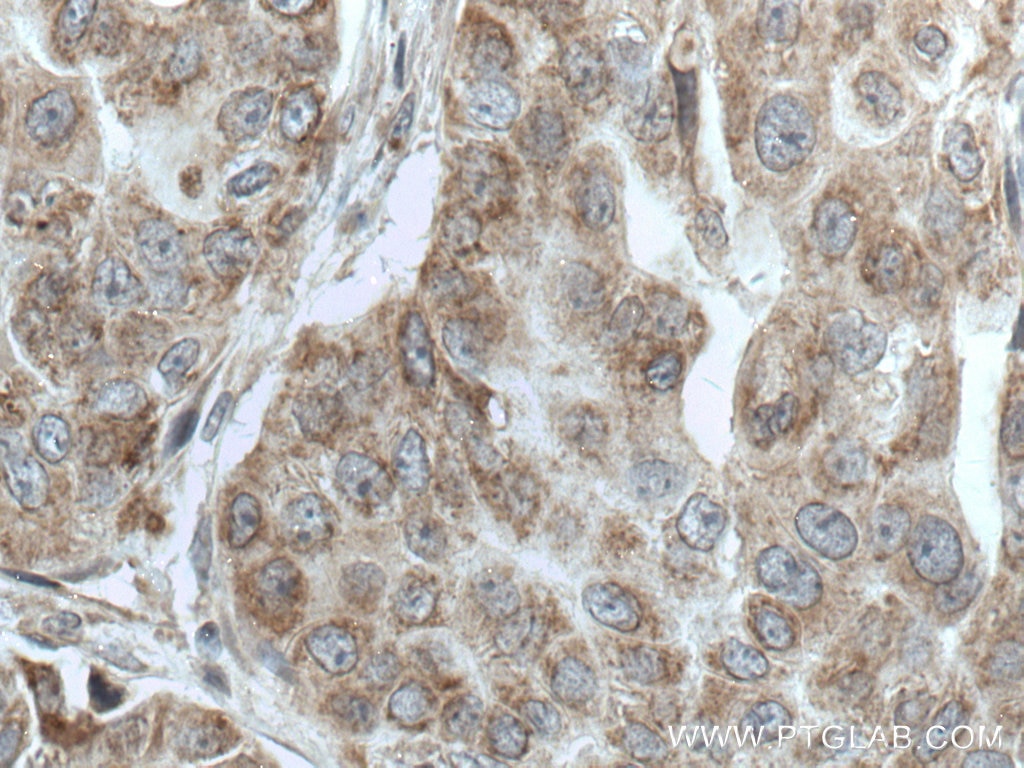 Immunohistochemistry (IHC) staining of human breast cancer tissue using TTC19 Polyclonal antibody (20875-1-AP)