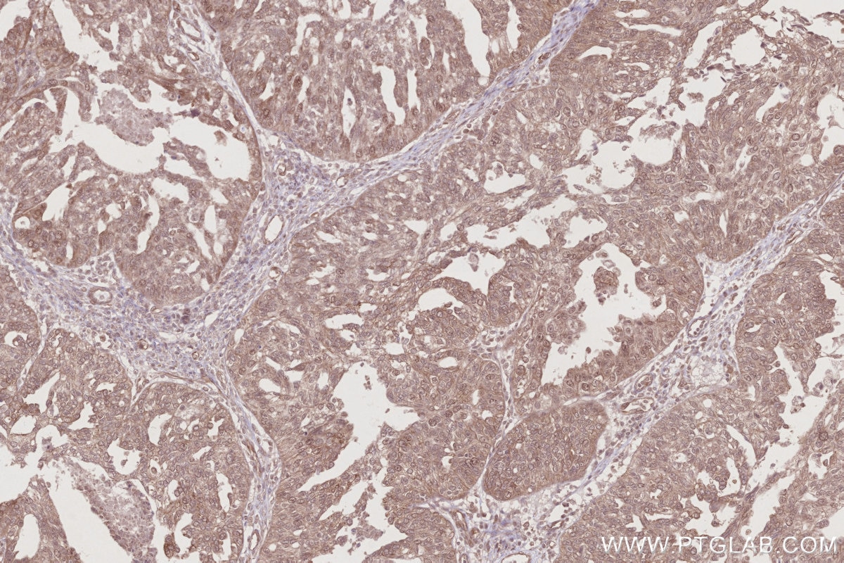 IHC staining of human ovary cancer using 25701-1-AP Immunohistochemistry (IHC) staining of human ovary cancer tissue using TTC28 Polyclonal antibody (25701-1-AP)