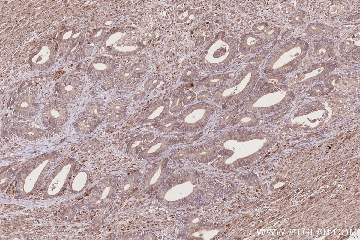 IHC staining of human rectal cancer using 25701-1-AP Immunohistochemistry (IHC) staining of human rectal cancer tissue using TTC28 Polyclonal antibody (25701-1-AP)