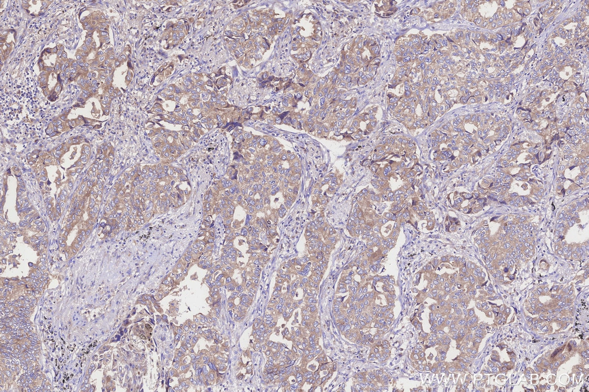 Immunohistochemistry (IHC) staining of human lung cancer tissue using TTC35 Polyclonal antibody (25443-1-AP)