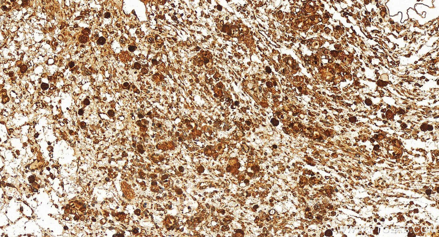 Immunohistochemistry (IHC) staining of human ovary cancer tissue using TTC35 Polyclonal antibody (25443-1-AP)