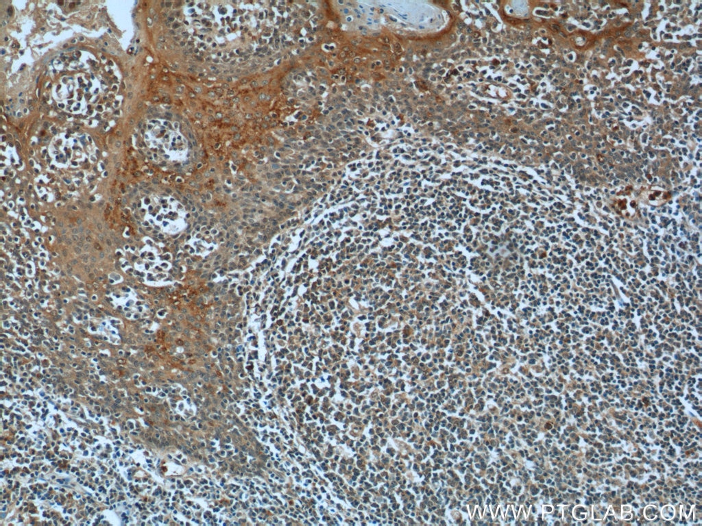 Immunohistochemistry (IHC) staining of human tonsillitis tissue using TTC37 Polyclonal antibody (24594-1-AP)