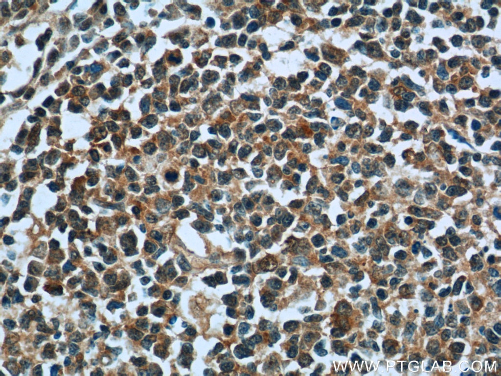 Immunohistochemistry (IHC) staining of human tonsillitis tissue using TTC37 Polyclonal antibody (24594-1-AP)