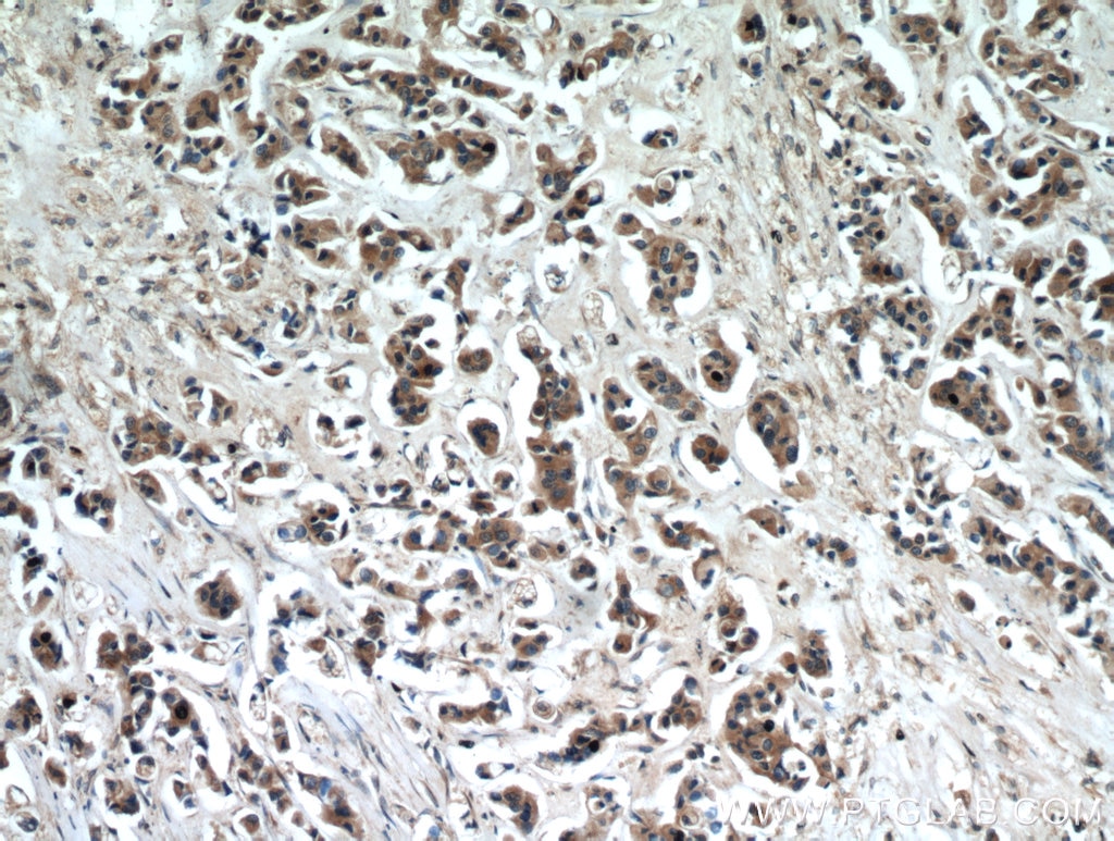 Immunohistochemistry (IHC) staining of human breast cancer tissue using TTC39A Polyclonal antibody (21323-1-AP)