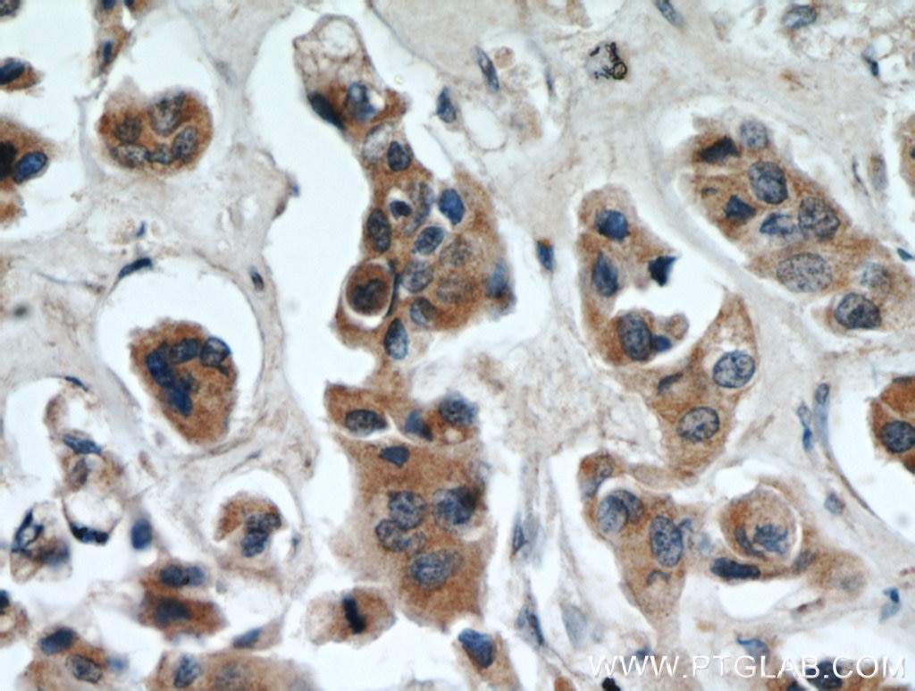 Immunohistochemistry (IHC) staining of human breast cancer tissue using TTC39A Polyclonal antibody (21323-1-AP)