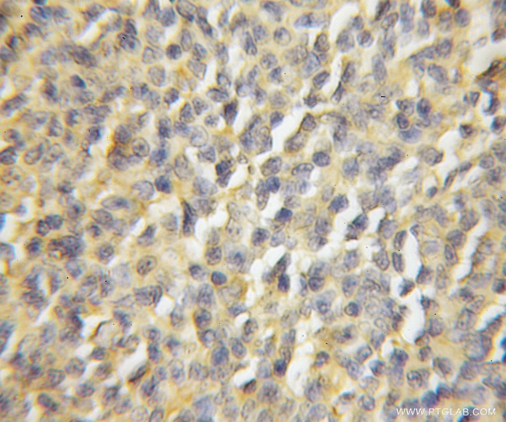 IHC staining of human lymphoma using 11878-1-AP