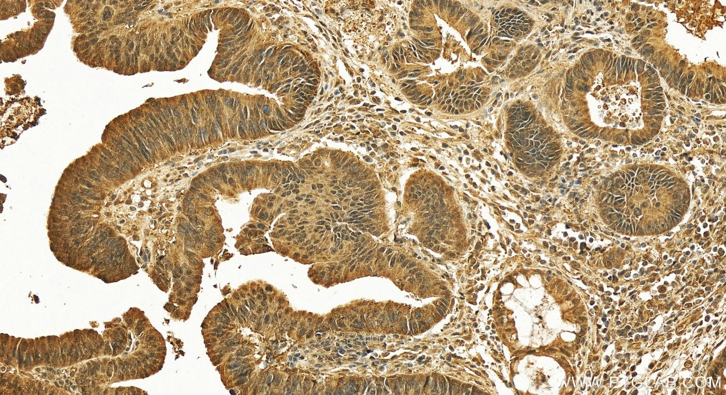 Immunohistochemistry (IHC) staining of human colon cancer tissue using TTC5 Polyclonal antibody (26112-1-AP)