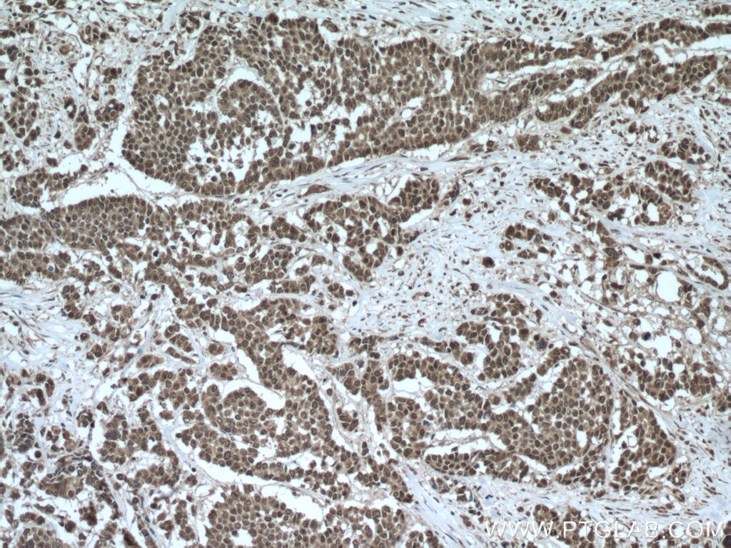 Immunohistochemistry (IHC) staining of human colon cancer tissue using TTC5 Polyclonal antibody (26112-1-AP)