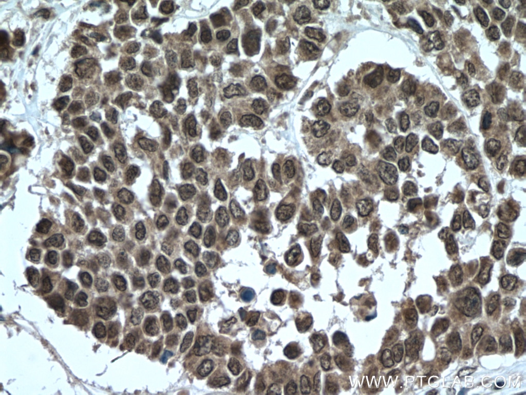 Immunohistochemistry (IHC) staining of human colon cancer tissue using TTC5 Polyclonal antibody (26112-1-AP)