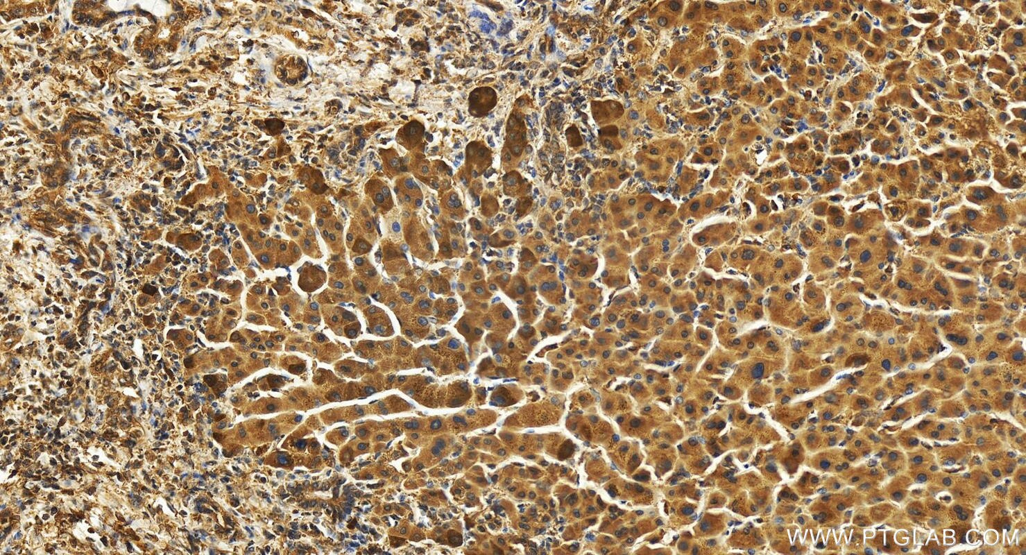 Immunohistochemistry (IHC) staining of human intrahepatic cholangiocarcinoma tissue using TTDN1 Polyclonal antibody (25410-1-AP)