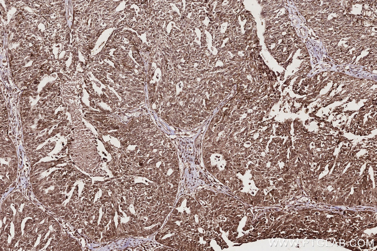 Immunohistochemistry (IHC) staining of human ovary cancer tissue using TTDN1 Polyclonal antibody (25410-1-AP)
