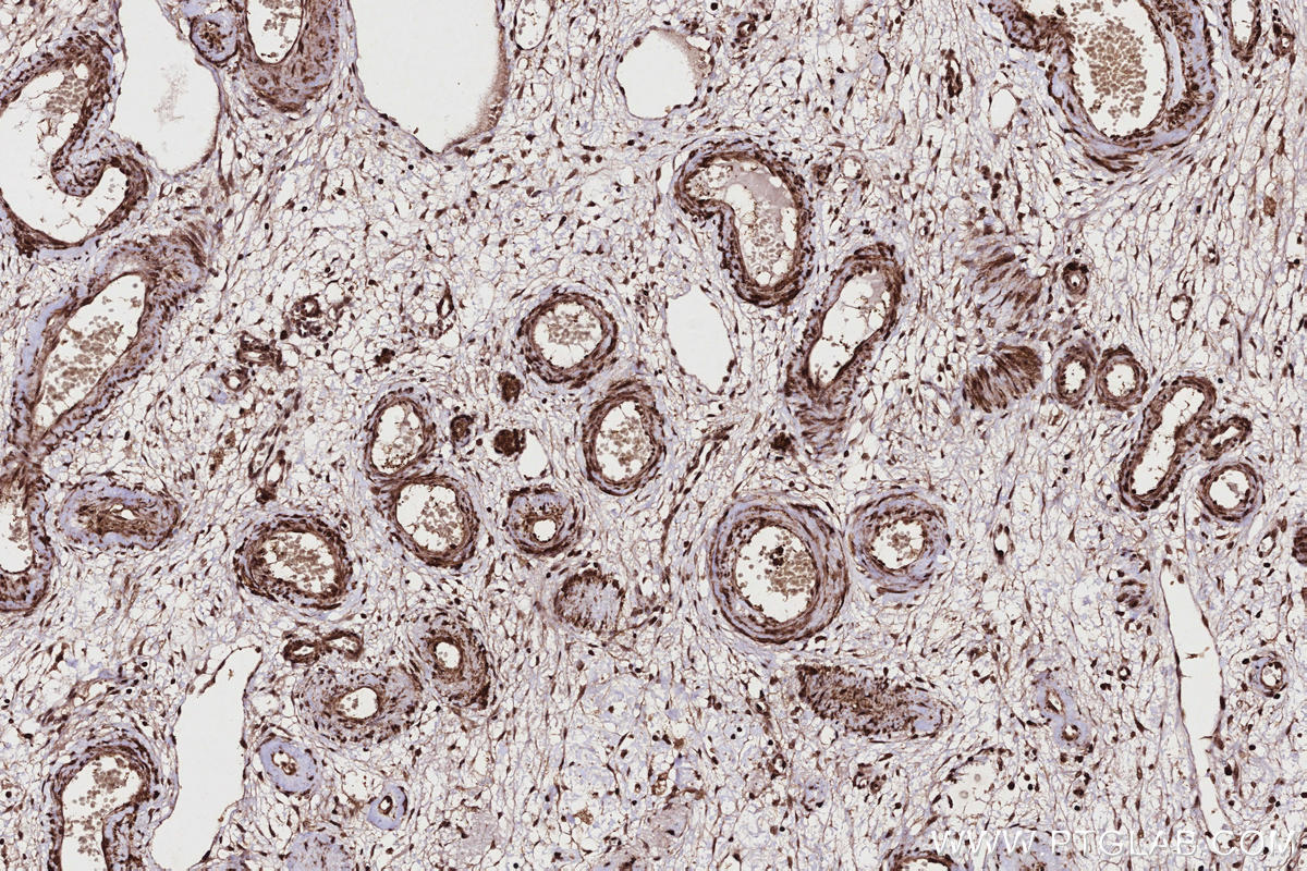 Immunohistochemistry (IHC) staining of human ovary cancer tissue using TTDN1 Polyclonal antibody (25410-1-AP)