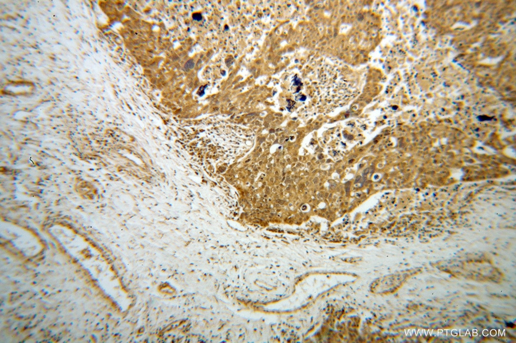 IHC staining of human ovary tumor using 13722-1-AP