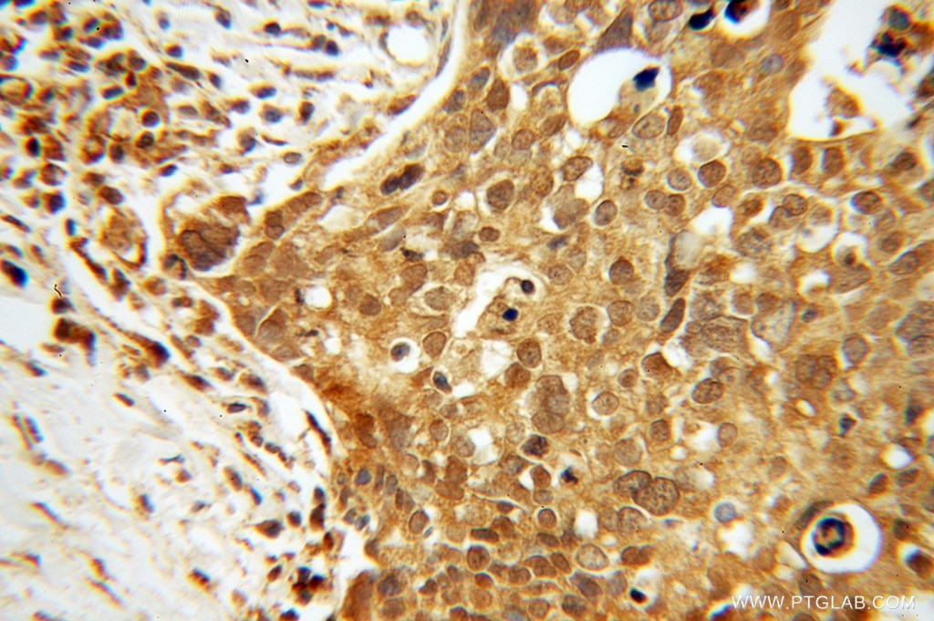 Immunohistochemistry (IHC) staining of human ovary tumor tissue using TTF2 Polyclonal antibody (13722-1-AP)