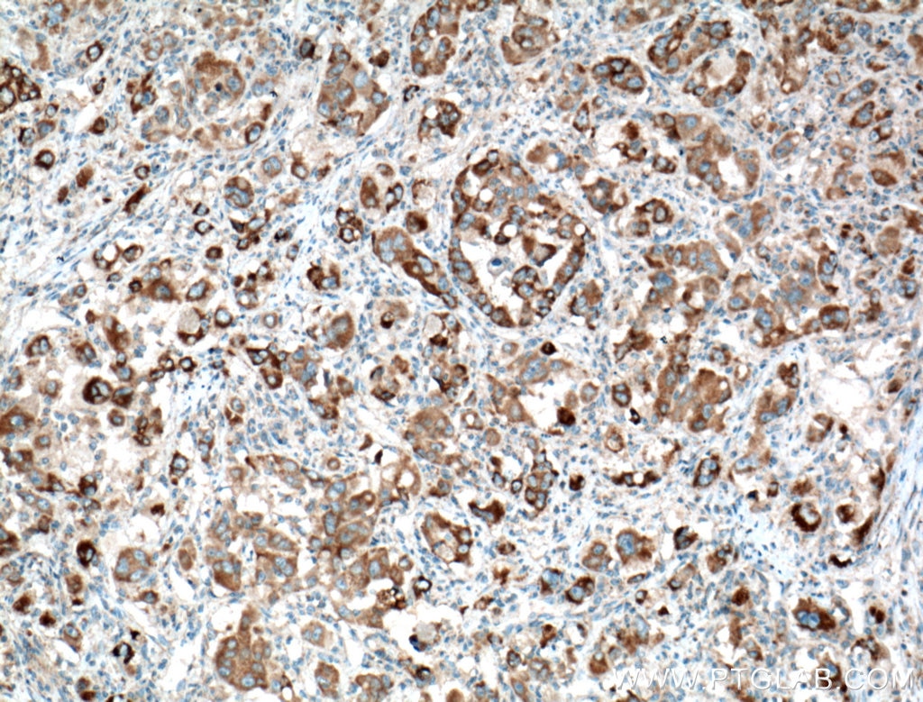 Immunohistochemistry (IHC) staining of human liver cancer tissue using TTK Polyclonal antibody (10381-1-AP)