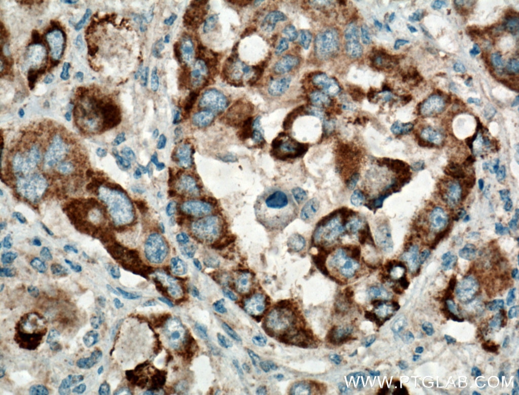 Immunohistochemistry (IHC) staining of human liver cancer tissue using TTK Polyclonal antibody (10381-1-AP)