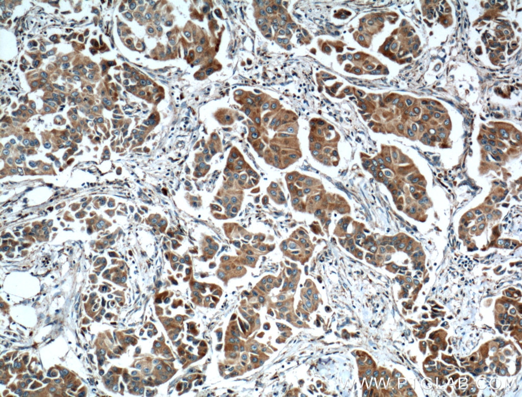 Immunohistochemistry (IHC) staining of human breast cancer tissue using TTK Polyclonal antibody (10381-1-AP)