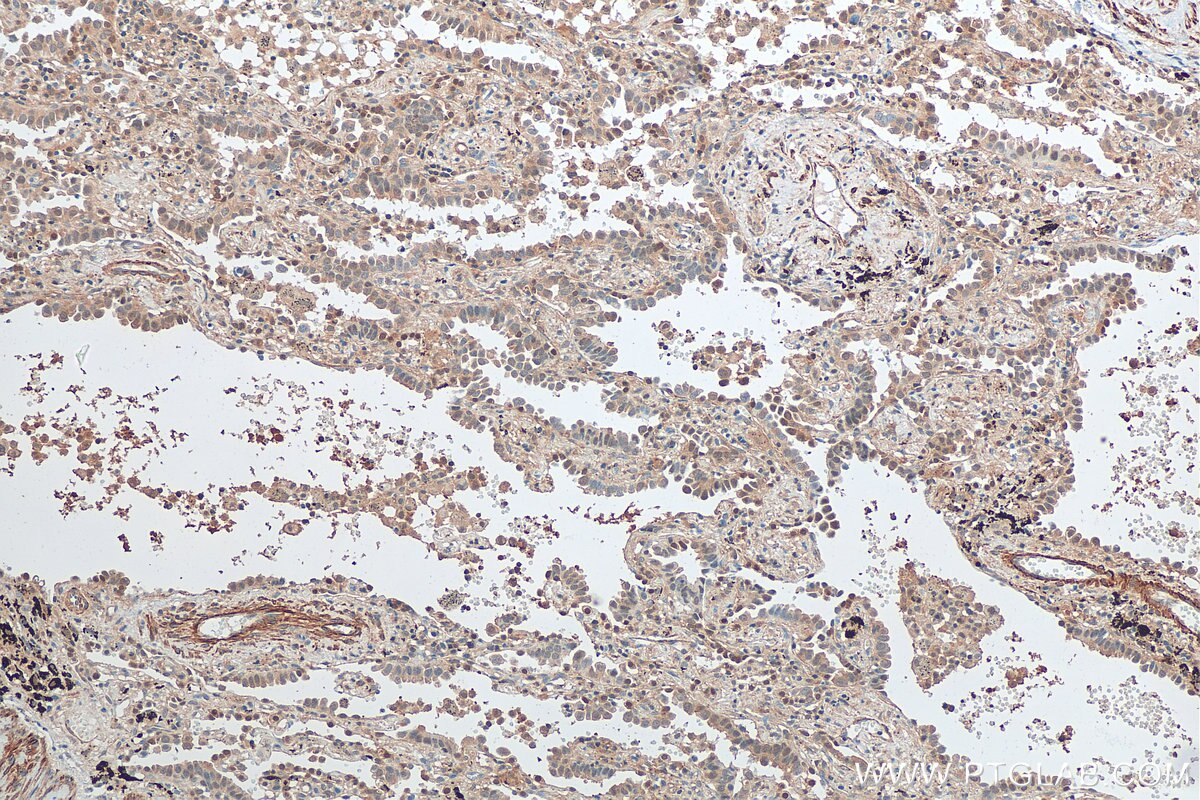 Immunohistochemistry (IHC) staining of human lung cancer tissue using TTLL12 Monoclonal antibody (68044-1-Ig)