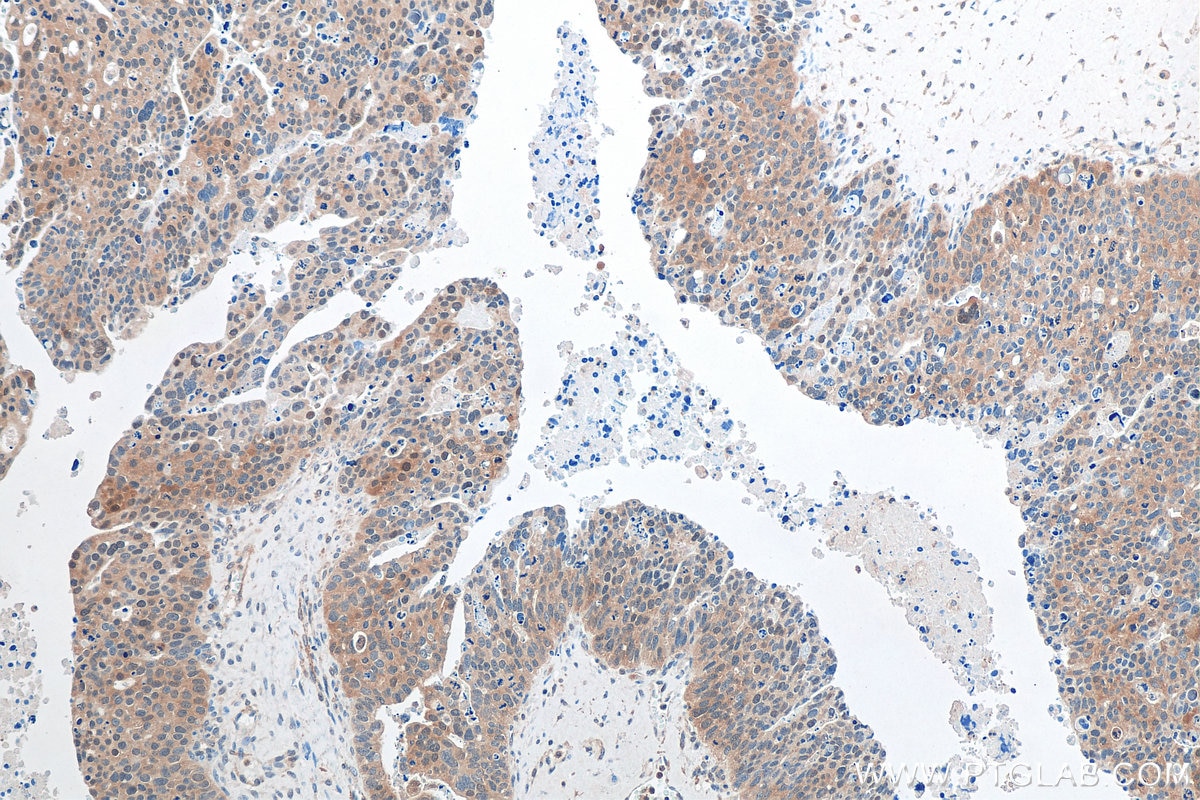 Immunohistochemistry (IHC) staining of human ovary tumor tissue using TTLL12 Monoclonal antibody (68044-1-Ig)