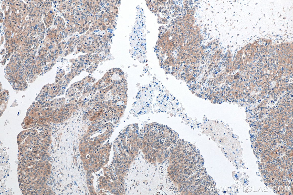 IHC staining of human ovary tumor using 68044-1-Ig