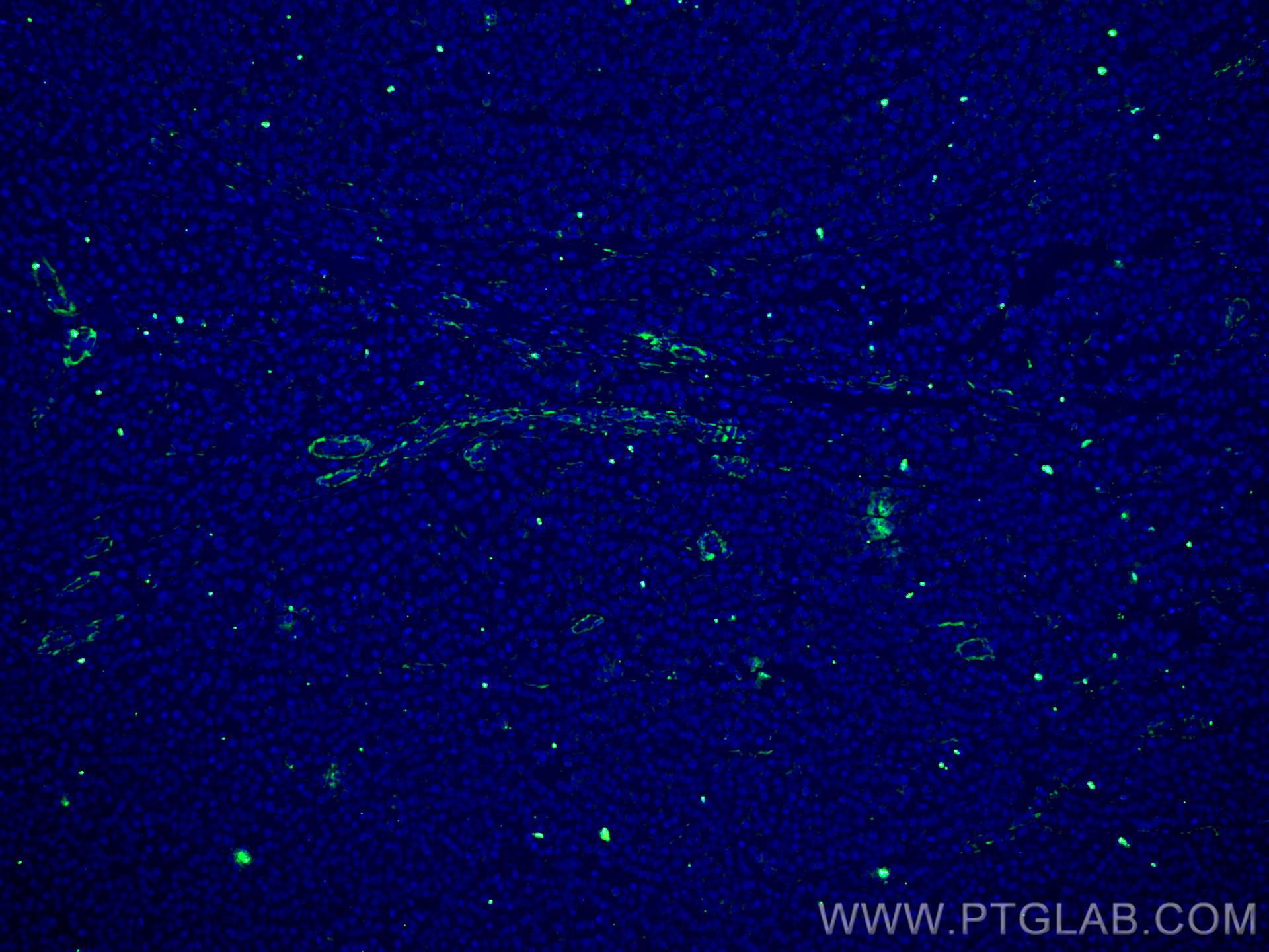 Immunofluorescence (IF) / fluorescent staining of human liver cancer tissue using TTPA Monoclonal antibody (67431-1-Ig)