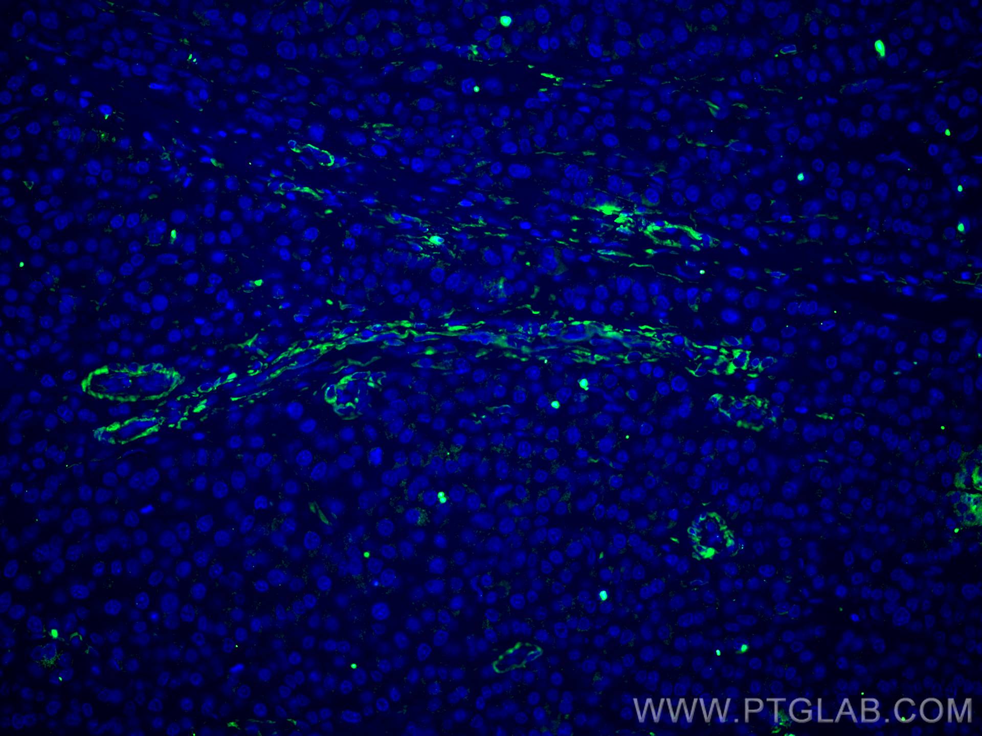 Immunofluorescence (IF) / fluorescent staining of human liver cancer tissue using TTPA Monoclonal antibody (67431-1-Ig)