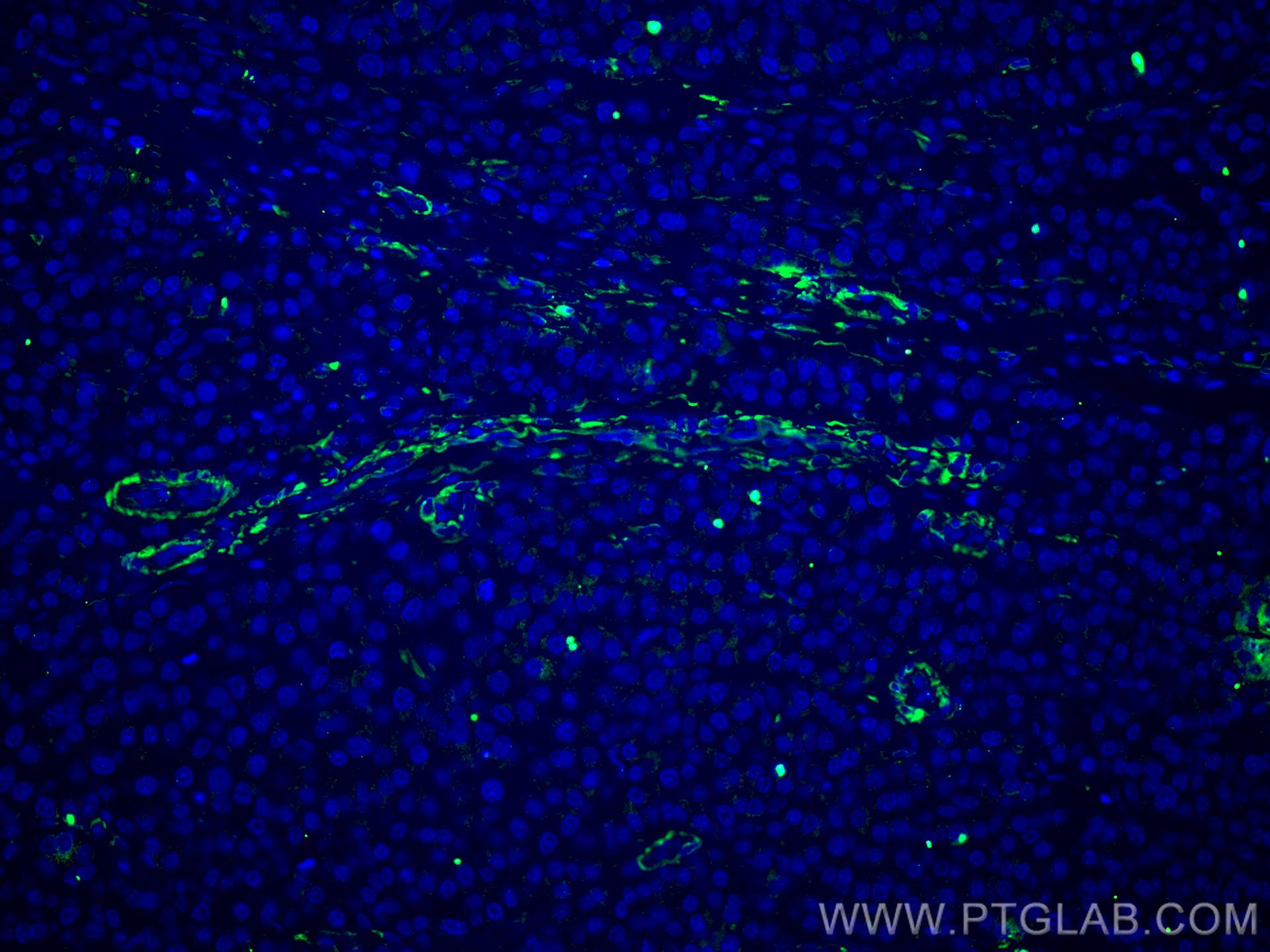 IF Staining of human liver cancer using 67431-1-Ig