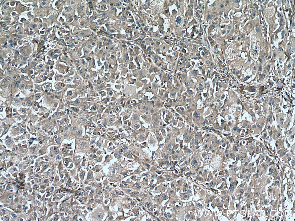 IHC staining of human liver cancer using 67431-1-Ig