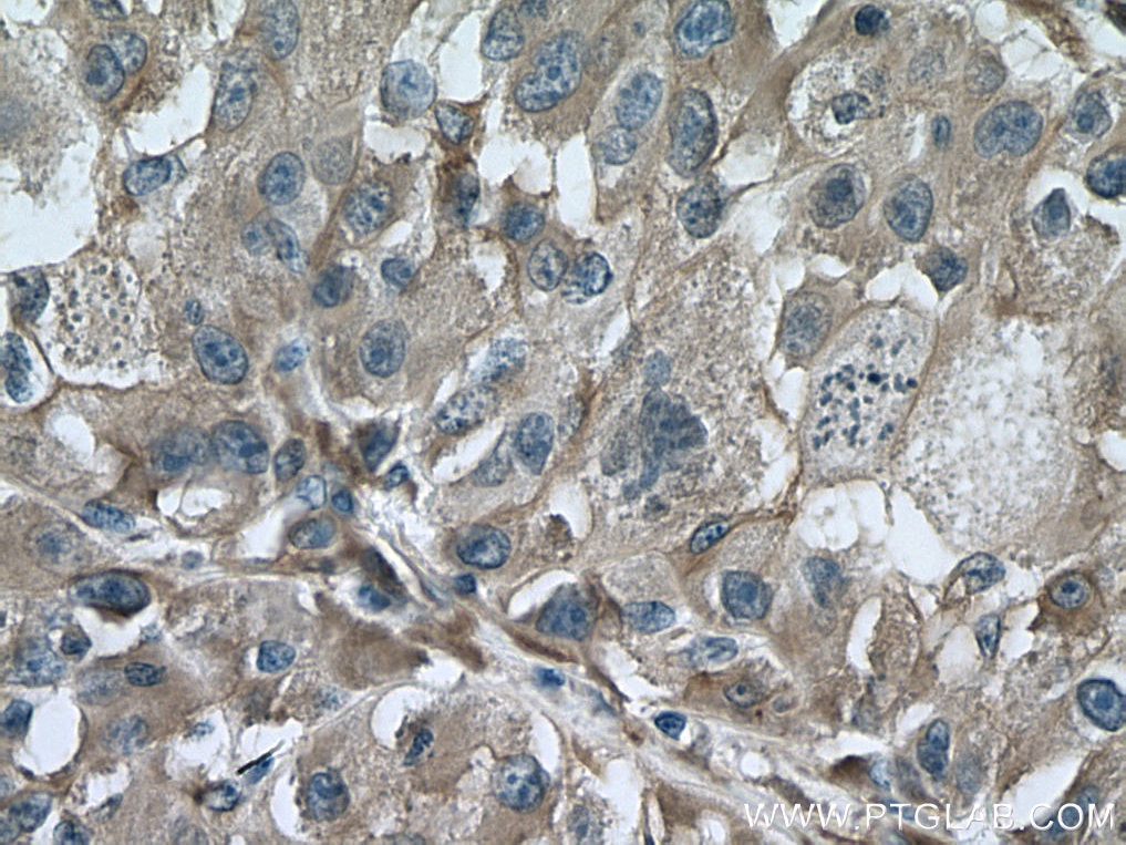 Immunohistochemistry (IHC) staining of human liver cancer tissue using TTPA Monoclonal antibody (67431-1-Ig)