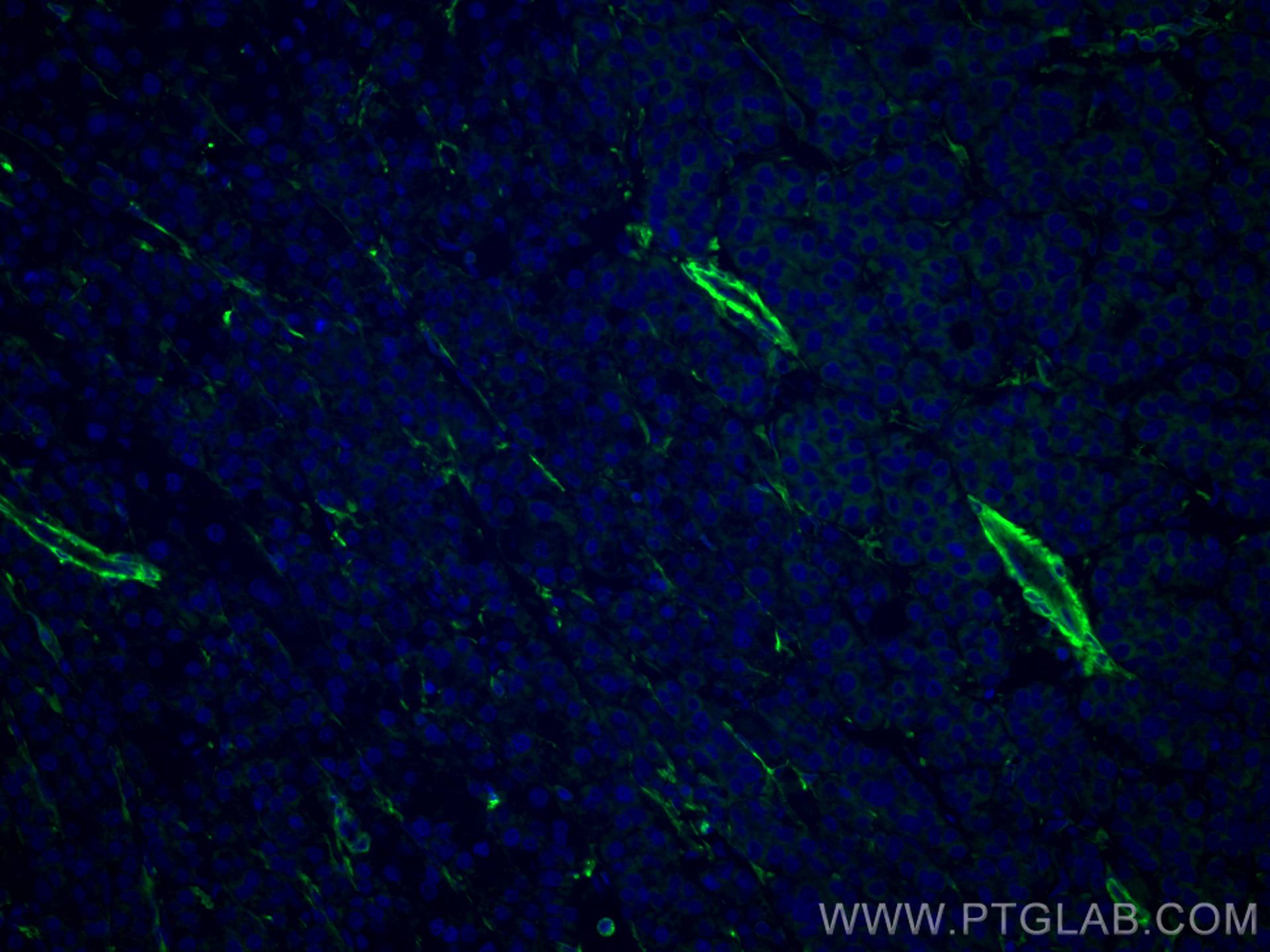 Immunofluorescence (IF) / fluorescent staining of human liver cancer tissue using CoraLite® Plus 488-conjugated TTPA Monoclonal anti (CL488-67431)
