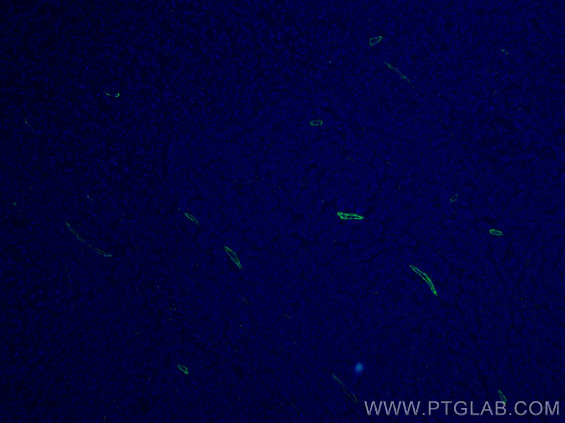 Immunofluorescence (IF) / fluorescent staining of human liver cancer tissue using CoraLite® Plus 488-conjugated TTPA Monoclonal anti (CL488-67431)