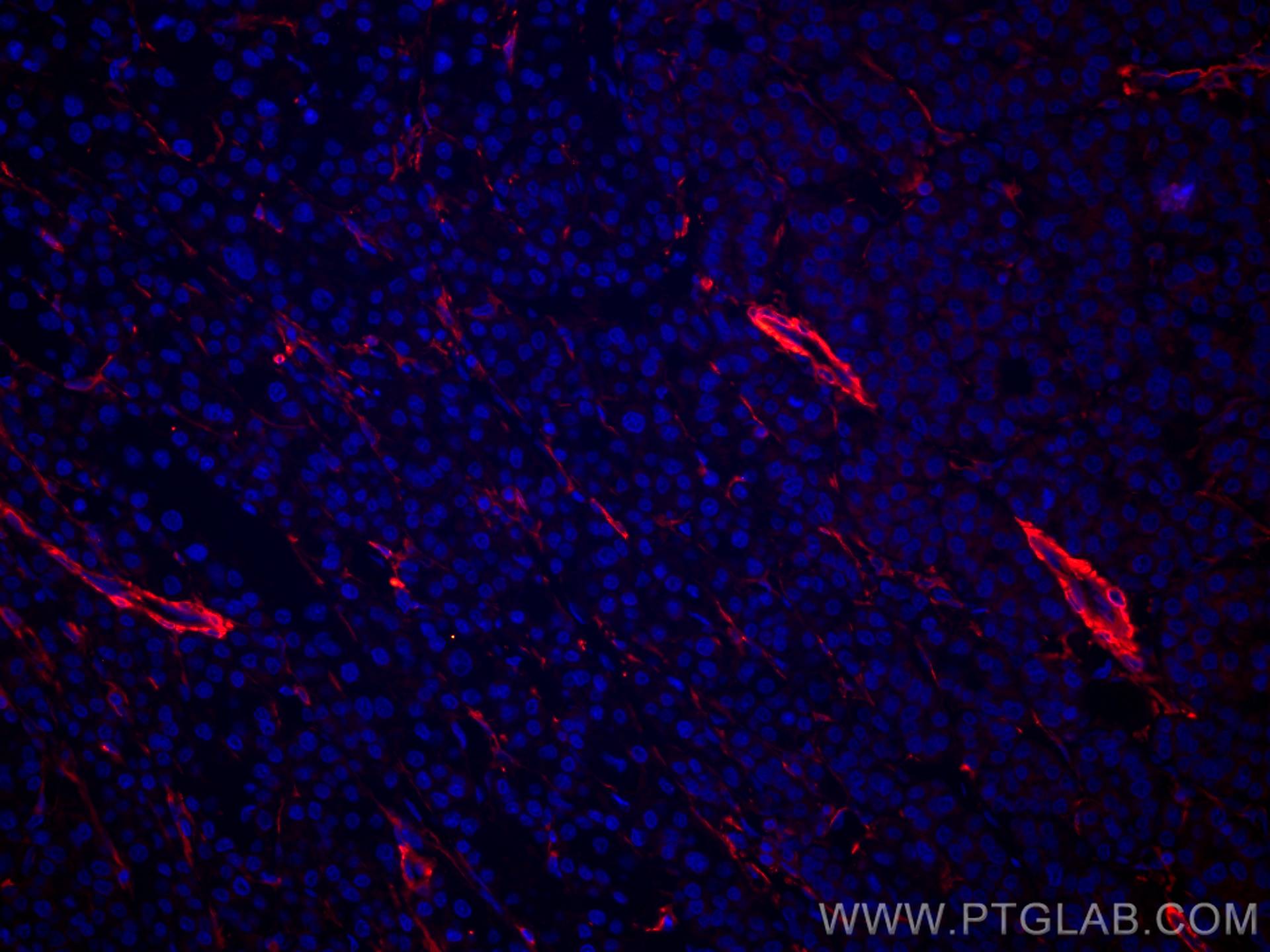 IF Staining of human liver cancer using CL594-67431