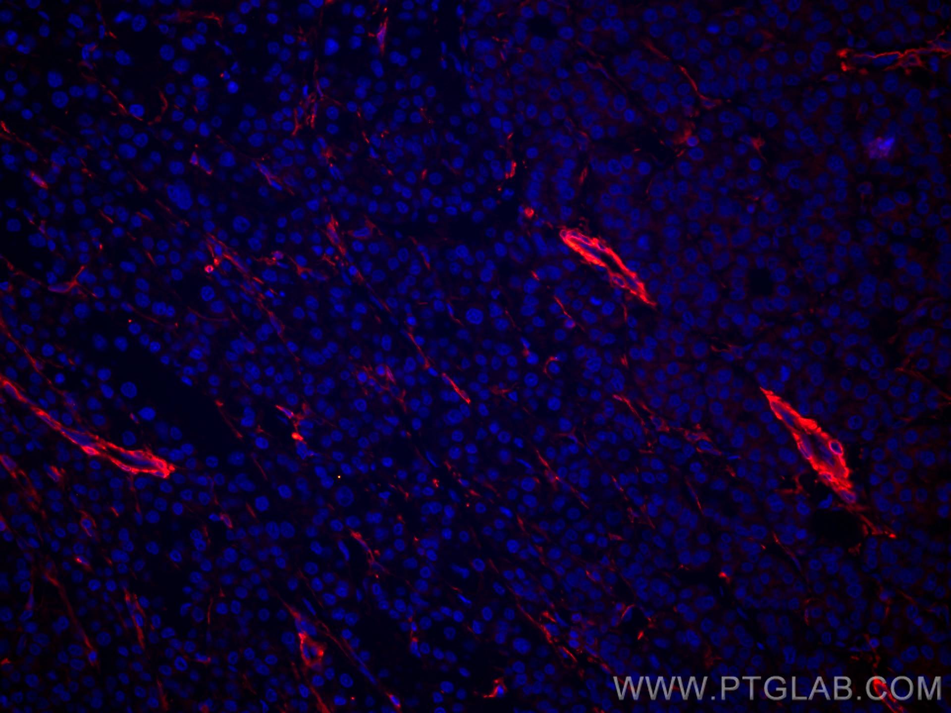 Immunofluorescence (IF) / fluorescent staining of human liver cancer tissue using CoraLite®594-conjugated TTPA Monoclonal antibody (CL594-67431)