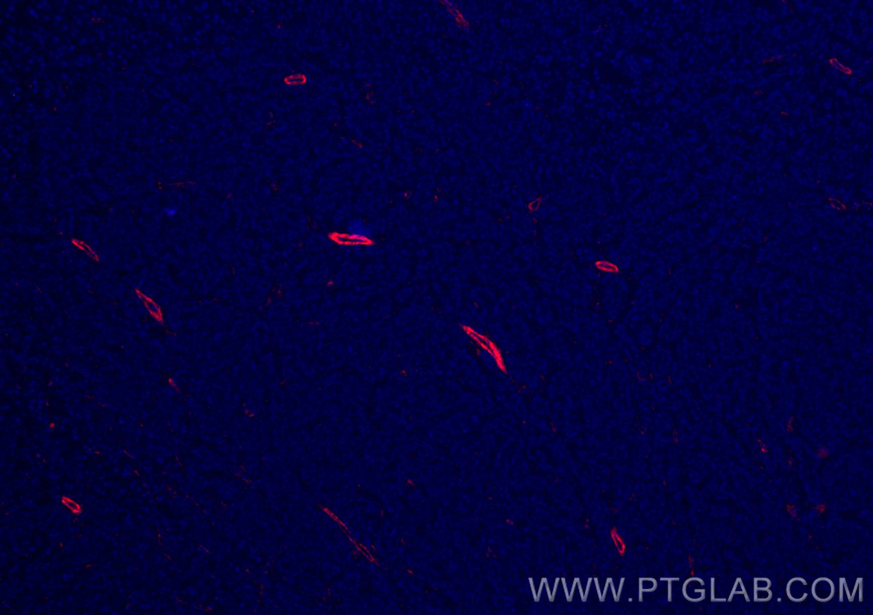 Immunofluorescence (IF) / fluorescent staining of human liver cancer tissue using CoraLite®594-conjugated TTPA Monoclonal antibody (CL594-67431)