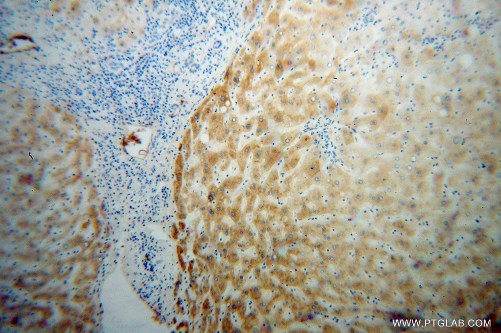 Immunohistochemistry (IHC) staining of human liver cancer tissue using Prealbumin/transthyretin Polyclonal antibody (11891-1-AP)