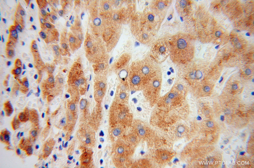 Immunohistochemistry (IHC) staining of human liver cancer tissue using Prealbumin/transthyretin Polyclonal antibody (11891-1-AP)