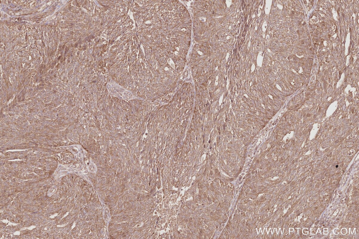 IHC staining of human ovary cancer using 26973-1-AP Immunohistochemistry (IHC) staining of human ovary cancer tissue using TTYH1 Polyclonal antibody (26973-1-AP)