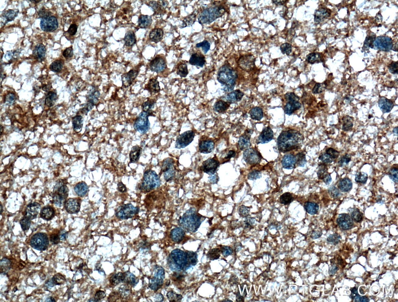 IHC staining of human gliomas using 26973-1-AP
