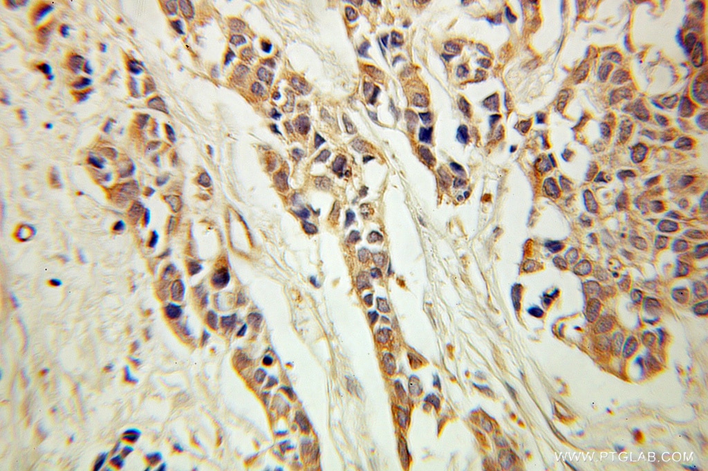 Immunohistochemistry (IHC) staining of human prostate cancer tissue using Alpha Tubulin Polyclonal antibody (10759-1-AP)