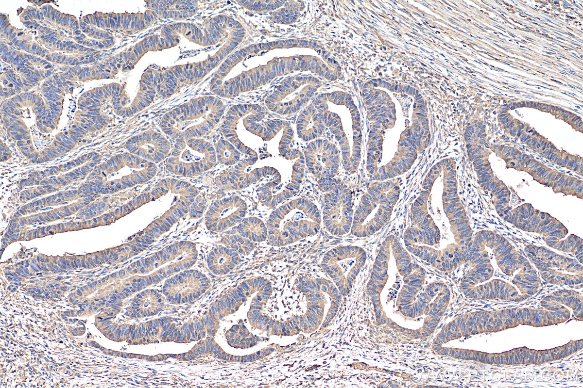 Immunohistochemistry (IHC) staining of human colon cancer tissue using Alpha Tubulin Polyclonal antibody (11224-1-AP)
