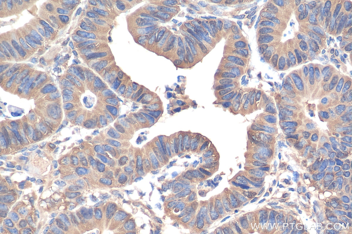 Immunohistochemistry (IHC) staining of human colon cancer tissue using Alpha Tubulin Polyclonal antibody (11224-1-AP)